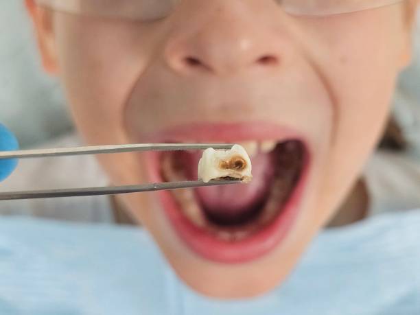 Best Emergency Wisdom Teeth Removal in Bealeton, VA